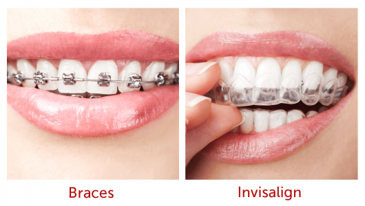 comparison-Braces-to-invisalign.png